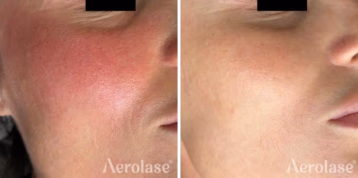 68091aeab0784ee5731ecce5_rosacea-Dr-Tatiana-Bogatyrenko