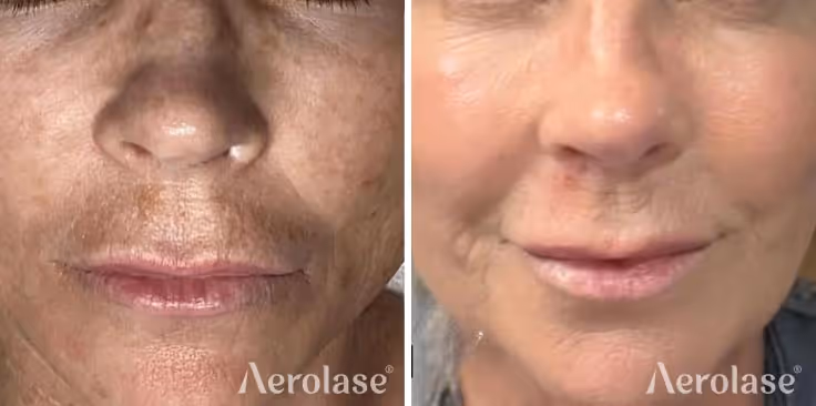 680a6f744ba68014a21d9498_homepage-results-sun-damage-medspa